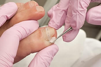 ingrown toenail in the Cary, NC 27513 area