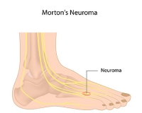Factors That Cause Morton’s Neuromas