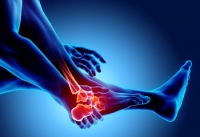 The Effects of Psoriatic Arthritis on the Feet